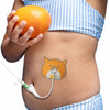 pediatric g tube protective pad worn by child soft cushion for stoma protection and comfortable daily use